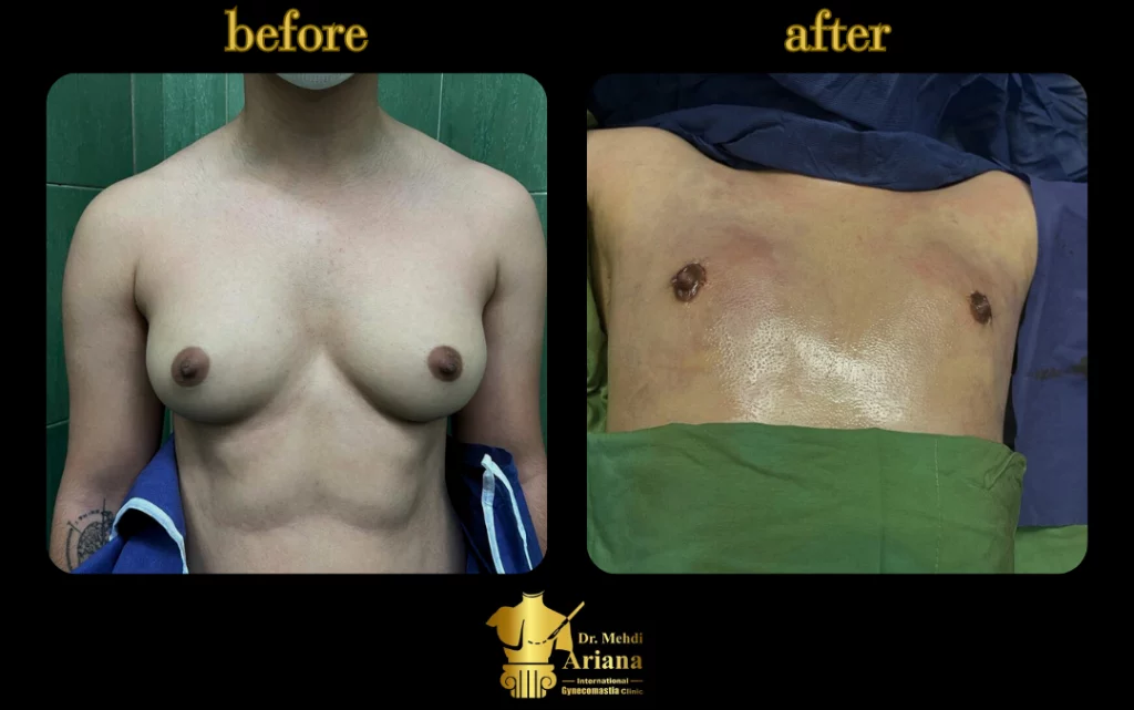 A gynecomastia surgery result