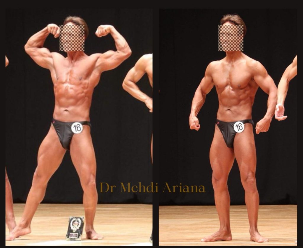 Dr Mehdi Ariana Surgery result