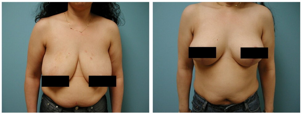 Breast Augmentation (Augmentation Mammoplasty) - Bruner Plastic Surgery